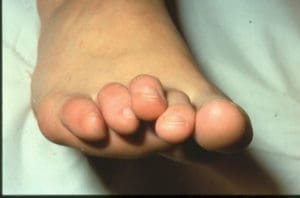 Lesser digit claw toes