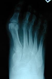 anterior posterior weight bearing Xray demonstrating hallux abducto valgus