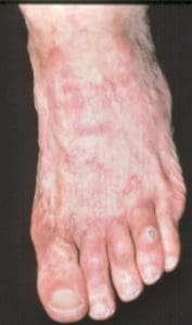 Foot with peripheral vascular disease
