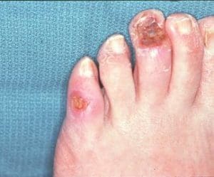 Foot with peripheral vascular diseasecomplications of 3rd nail bed and 5th digit