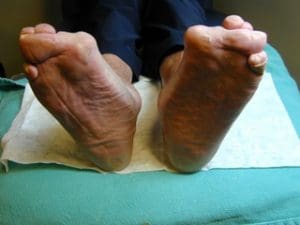 Bilateral rheumatoid arthritis