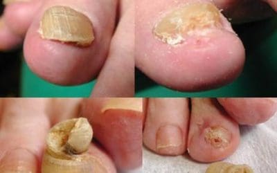 More than “Old Age.” Why nails thicken and how to manage them