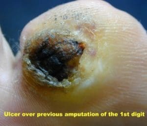 Ulcer on previously amputated big toe