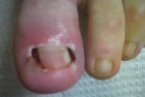Bilateral partial nail avulsion of hallux