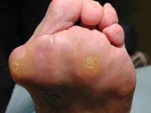 Patient with bunion and callus