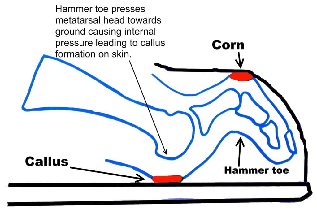 Hammer toe with dorsal pressure point from shoe causing a corn