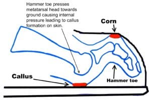 Hammer toe with dorsal pressure point from shoe causing a corn