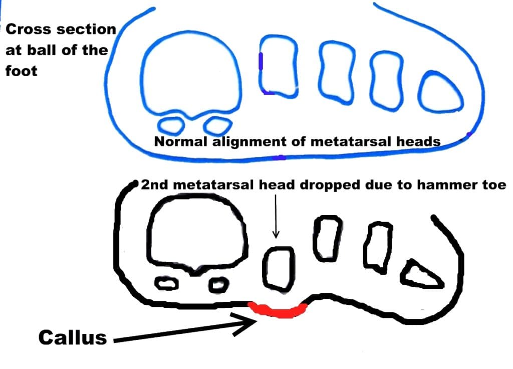 Frontal view metatarsals heads normal vs plantarflexed metatarsal head