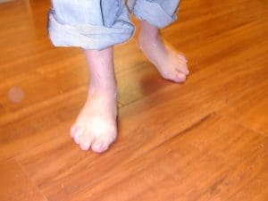 Pes planus foot during gait