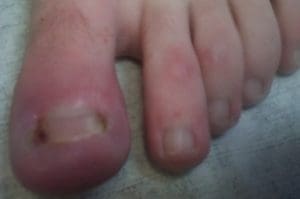 Infected ingrown nail on both sides