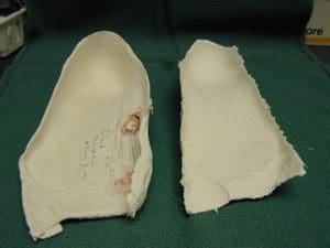 Plastar cast of right cast compared to left cast with markings inside the right cast for special modifications to right custom foot orthotic