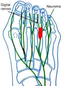 Diagram of a neuroma between 4th and 5th metatarsal heads