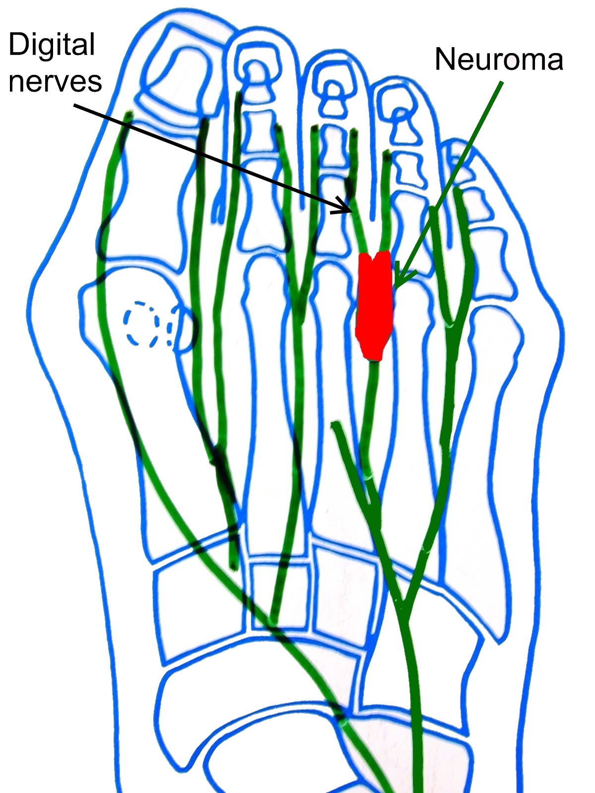 neuroma