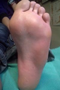 left VPs cleared after 4 weeks of treatment