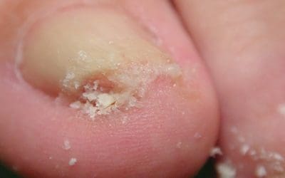 Why Are My Toenails Thick and Curved? A Chiropodist’s Perspective