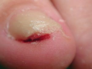 Debris removed from the nail sulci