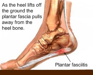 Plantar Fasciitis