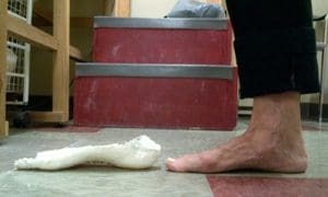 Side by side corrected cast and flat foot comparison