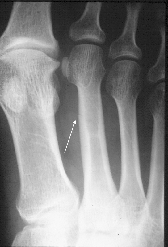 stress_fracture_2nd_metatarsal