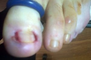 Tourniquet on the big toe