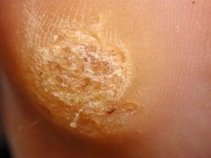Plantar wart