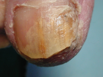 Fungal nail before reduction