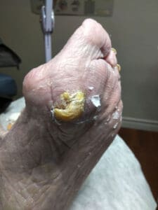 Side view 1st metatarsal head horn corn