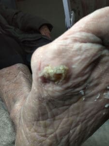 Partially debrided horn corn on plantar 1st metatarsal head