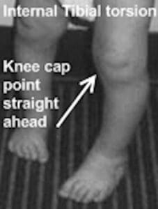 Internal tibial torsion in gait