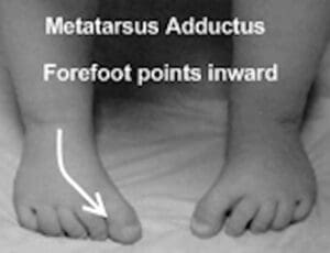 Metatarsus adductus in child while standing