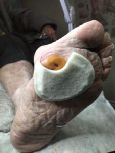 Removed plantar corn with padding