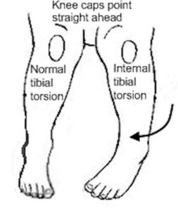 internal tibial torsion