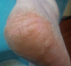 Reduced heel fissures