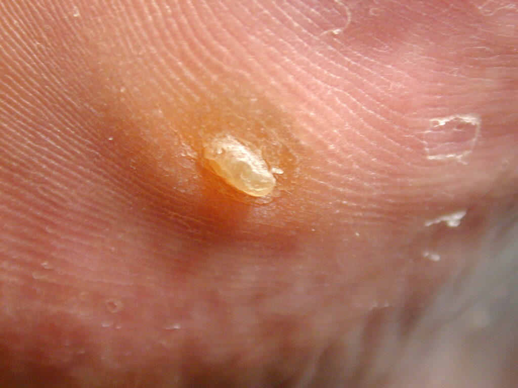 Corn vs corn removed on plantar 5th metatarsal head