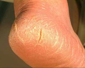 Heel fissures