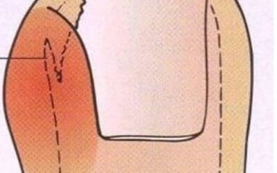 Ingrown Toenails: What You Need to Know